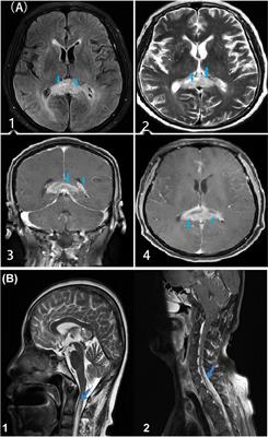 Case Report: H3K27M-Mutant Glioblastoma Simultaneously Present in the Brain and Long-Segment Spinal Cord Accompanied by Acute Pulmonary Embolism